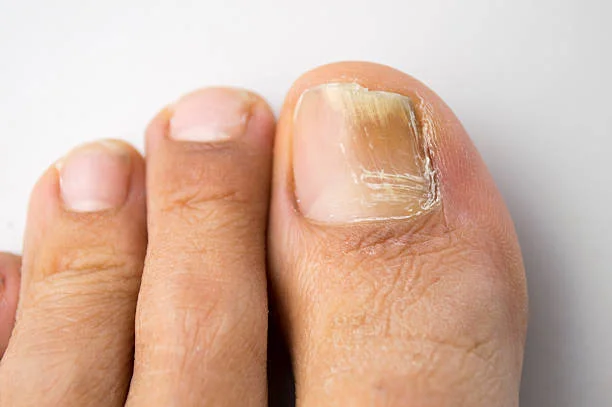 terracalm infected toe