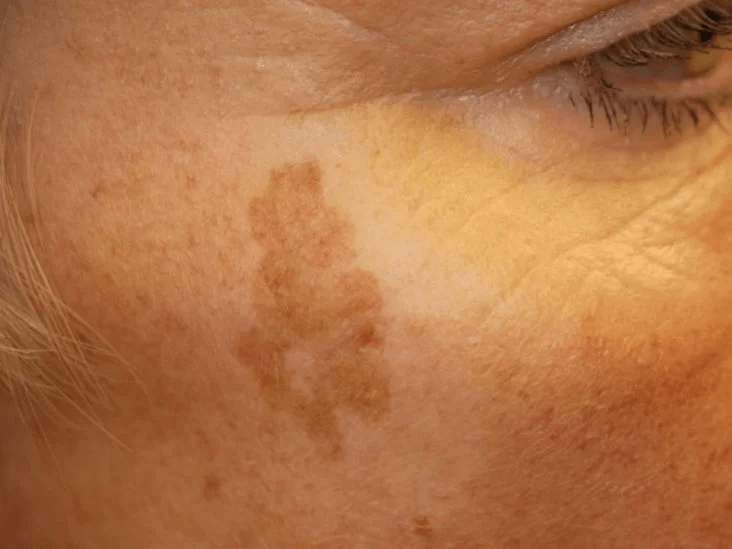 dark spot patch on a womans face