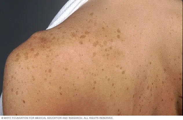 dark spots on shoulder and back